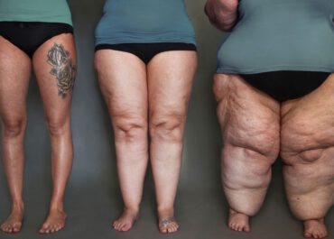 Lipödem erkennen: Welche Anzeichen wirklich typisch sind