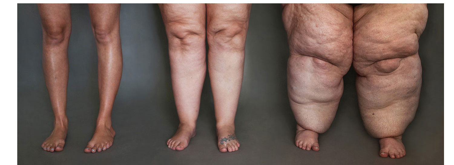 Slider_Lipödem-Bonn-Stadieneinteilung